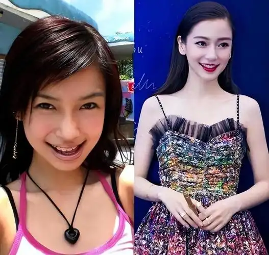 确实,杨颖虽然拥有混血血统,但一出生就是一口大龅牙,这也是她最致命