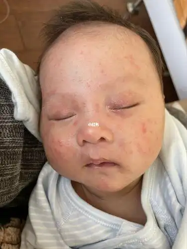新生儿粉刺很严重怎么办新生儿起粉刺怎么办
