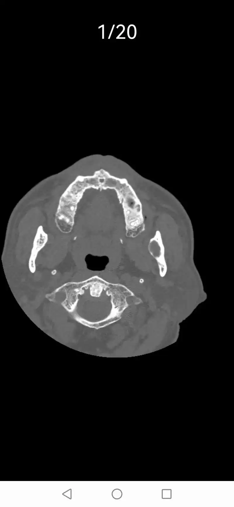 57岁,牙痛拍片发现左下颌骨囊肿1月  患者1月前牙痛就诊, - 抖音