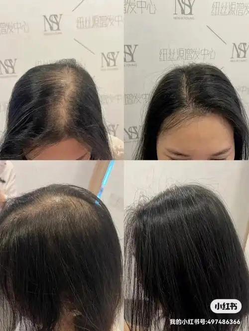 头顶稀疏解决方法很简单