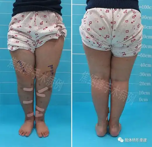 2017-12-24焦绍锋 王振军肢体矫形重建双侧重度膝内翻,俗称"罗圈腿"