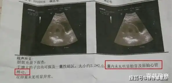 明明怀孕了,可孕囊怎么是空的?67_胚胎_检查_因素