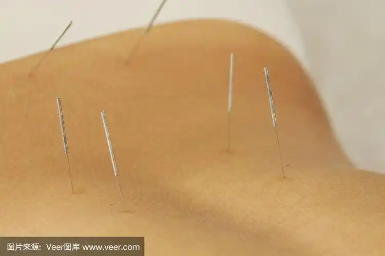 女性背部与钢针针灸治疗过程中