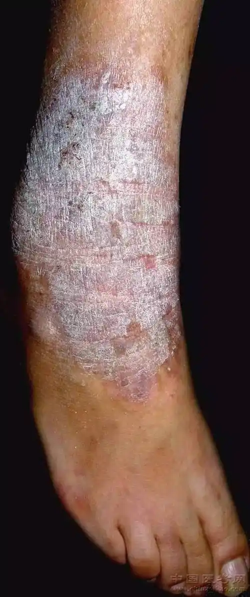 史上最全的皮肤病图谱来了(修订版)!