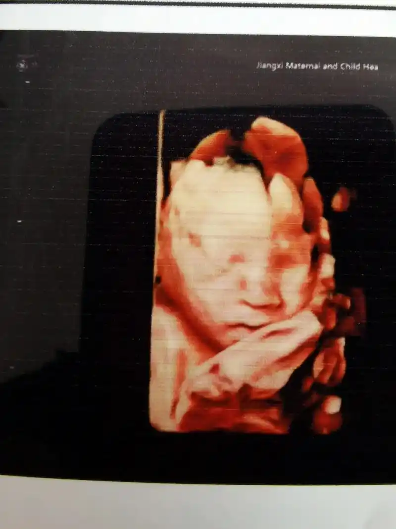 胎儿系统超声检查(iii级胎儿上唇皮肤未见明显中断所见:中孕 - 抖音