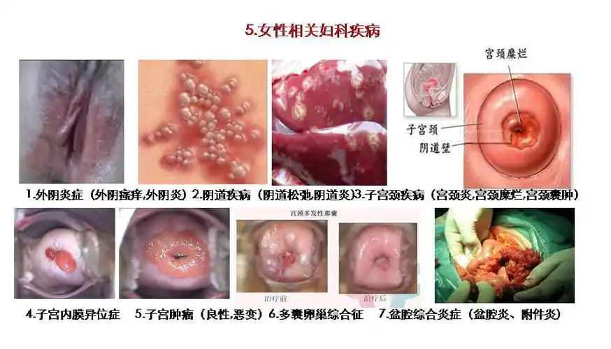 妇科疾病的演变