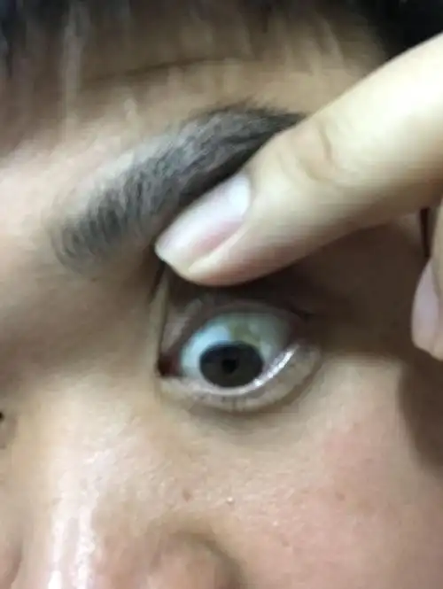 白眼球上有一块黄斑,是什么?能去除吗?并没有不适症状很长时间了