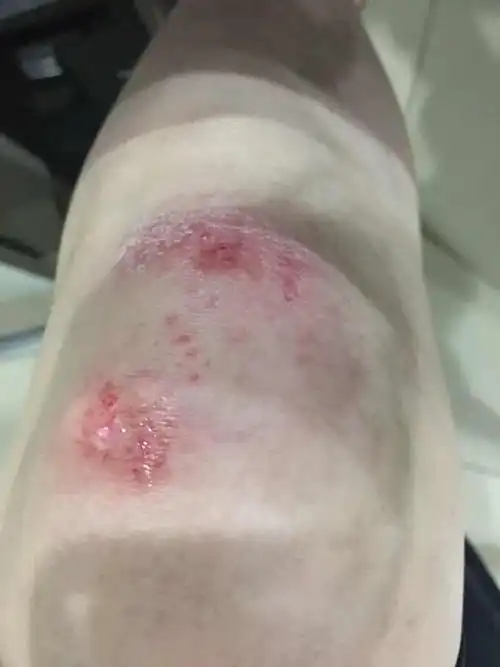 摔伤了,第二天,洗澡的时候水蒸气太重,伤口发白,可以直接涂芦荟胶吗