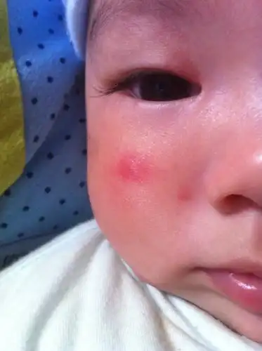 宝宝4个半月.最近几天脸上长了东西.快好了又冒出来.还很大颗,很红.