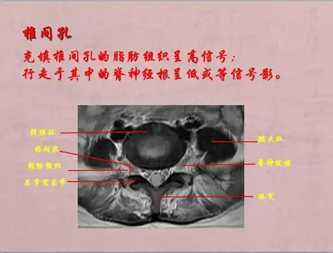 腰椎核磁共振第36次作业