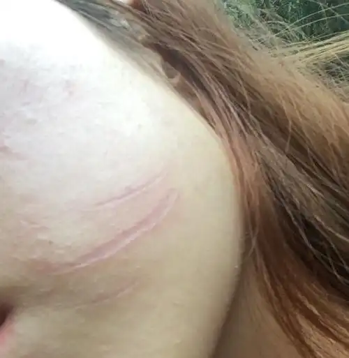 脸部抓痕20天 现在有凹痕 它会张平吗?需要多久?怎么治疗