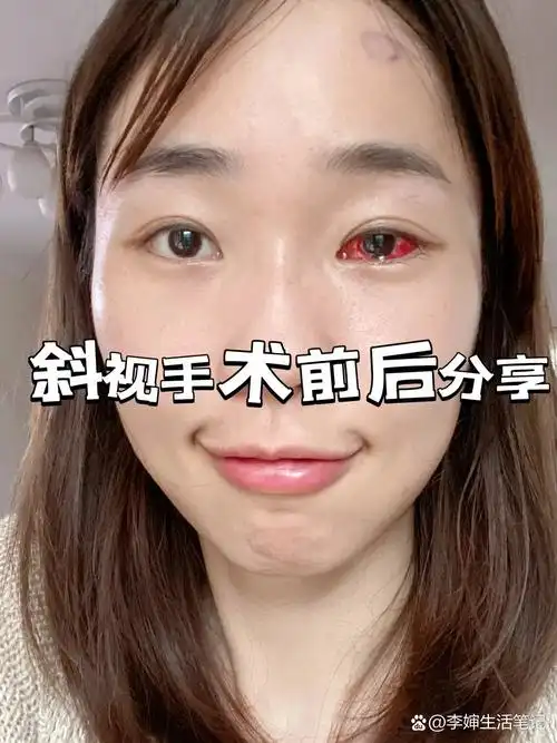 斜视手术前后分享