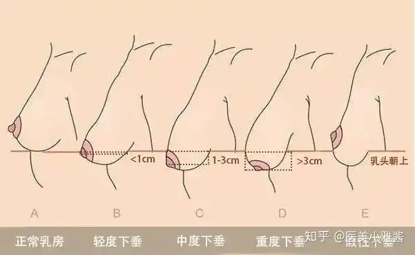 乳房下垂:双环?倒t?花苞?不同矫正术如何选择? - 知乎