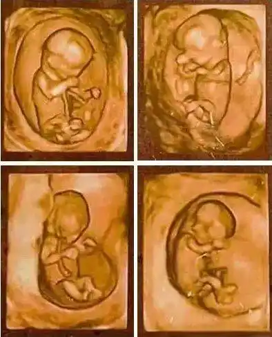 颈后透明带的超声检查依赖于医生诊断的经验,b超机器的灵敏度,因此是