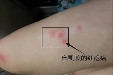 床虱咬的红疙瘩