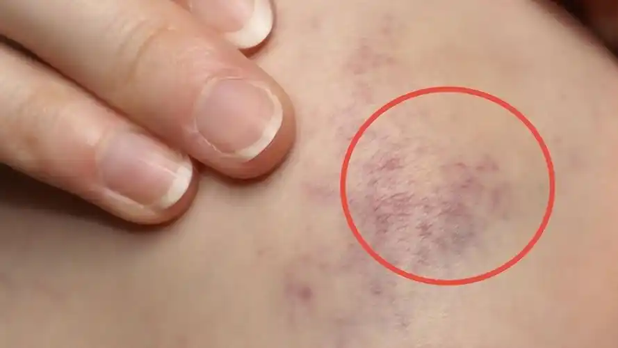 肝癌和白血病都有同1个信号,皮肤上有这个"标志"的人,请小心