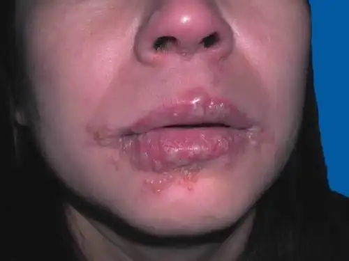 口周水泡,疼痛是咋回事?得了单纯疱疹,怎么办?_单纯疱疹 - 好大夫在线