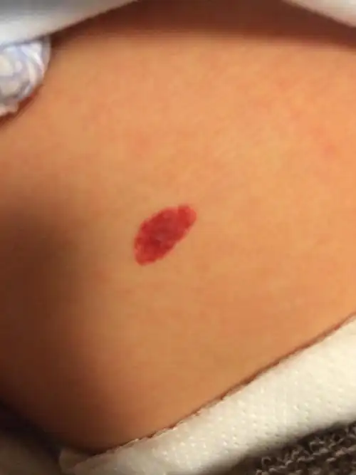 宝宝一个半月,肚皮上长的这个红斑是胎记还是什么?