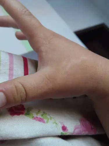 浏览  33333  满意回答 宝宝的状况有可能是真菌感染引起的长汗斑