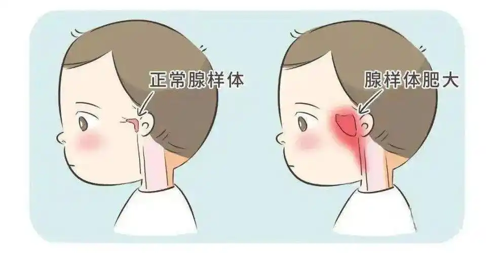 腺样体肥大有什么影响?听成都民生耳鼻喉医院解答:腺样体肥大的危害 -