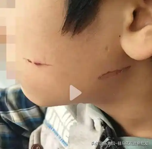 我40多岁的脸上也有一条这样的伤疤,就是我初中时一个混蛋同学在我