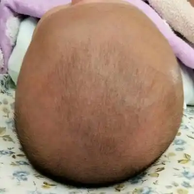 宝宝偏头严重怎麼办!