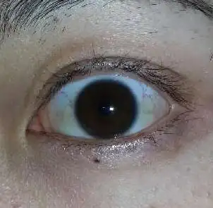 眼白发黄发蓝是怎么了