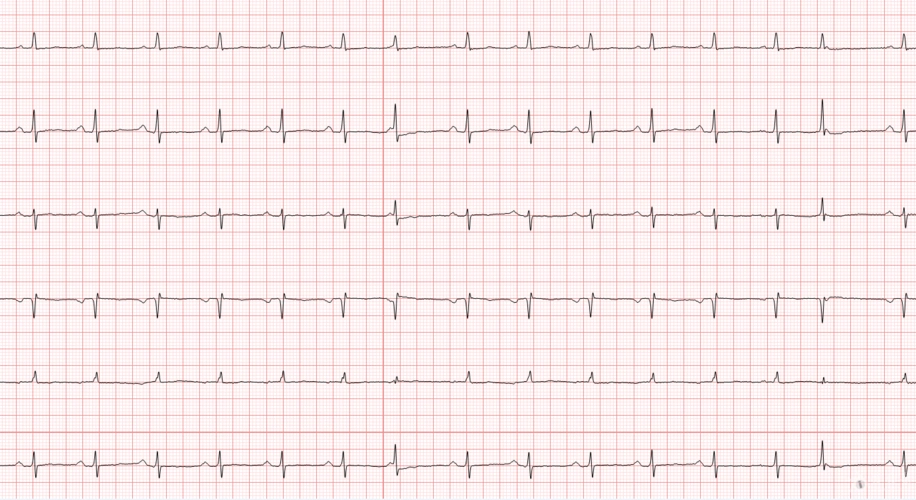 冬秋-心电图讨论20170212-图中三个异常qrs如何考虑
