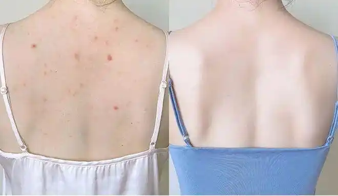淼淼:后背来总是会长痘痘,有时候还奇痒无比,闺蜜说可能是螨虫过敏