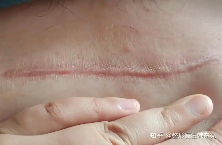 剖腹产后怎么样进行疤痕的处理? - 知乎