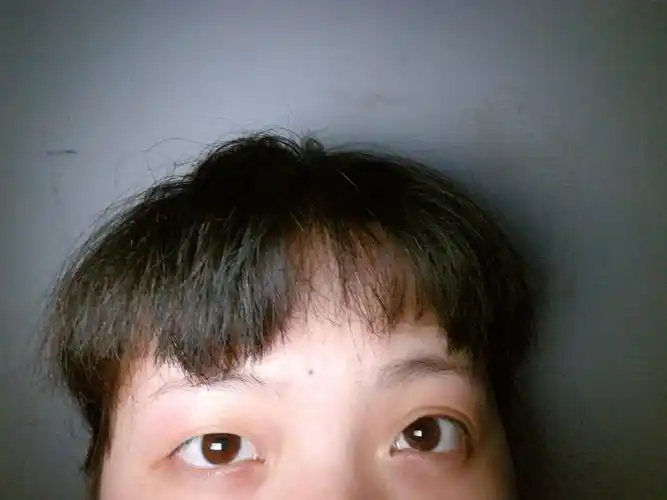 20岁的大小眼少女,眼睛一单一双,单眼皮的那只上眼皮从小到大都有一道