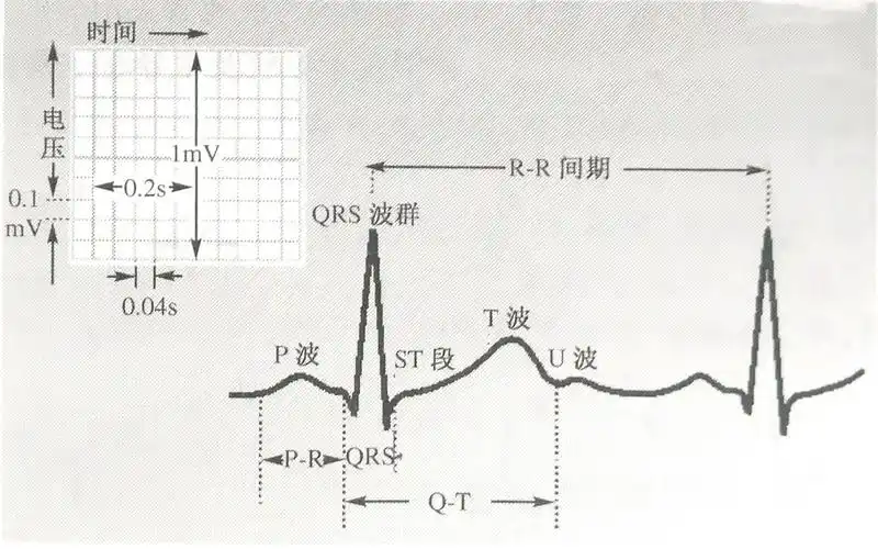 st段压低就一定是冠心病心电图究竟该怎么看让你不再疑惑