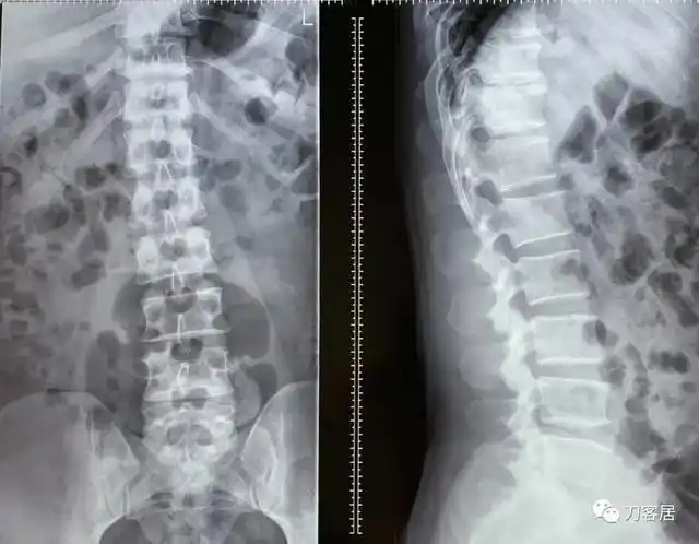 我的门诊病历:腰5骶1椎间盘突出症,保守治疗