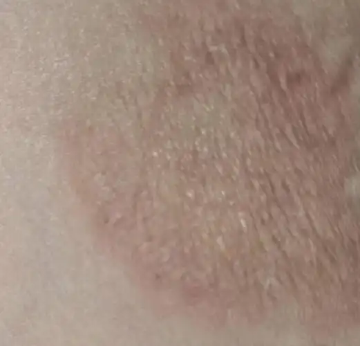 因为这边yq 出入97很麻烦 这个东西还不疼不痒 只是有一块皮肤发皱