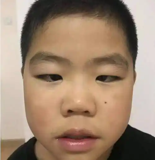 斜视配什么眼镜小孩斜视怎么治疗