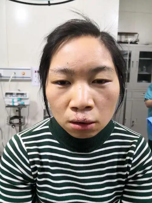 唇裂二期修复