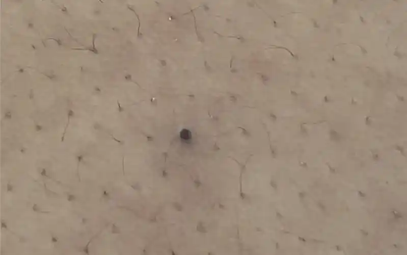 背上竟然长了一颗黑头