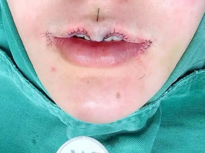 今天刚做完微笑m唇,肿胀感不明显,手术