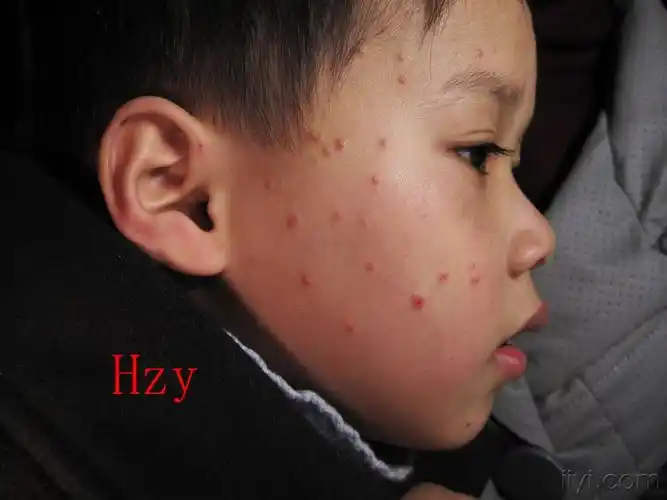 小儿两侧脸部两手两下肢的丘疹已一个月