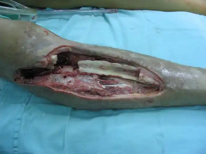 ppt:急性骨髓炎患者护理  文件 ppt:骨与关节结核患者的护理 文件