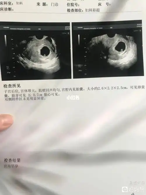 【通过胎囊形状判断怀男怀女靠谱吗?】_怀孕_母婴_孕产经验