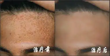 扁平疣规范治疗是关键-郑州华肤专家讲解