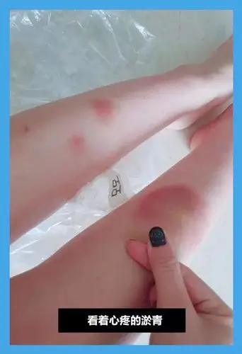 "让人心疼".伤痕累累的女爱豆