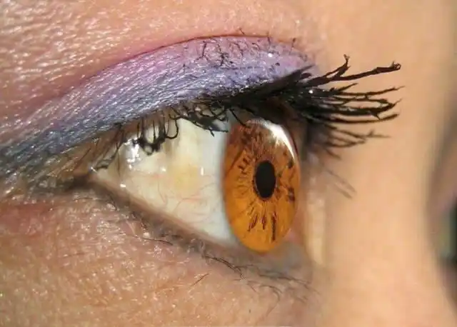 眼白发黄可能属于这3种情况