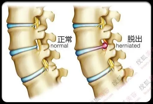 颈椎增生的症状