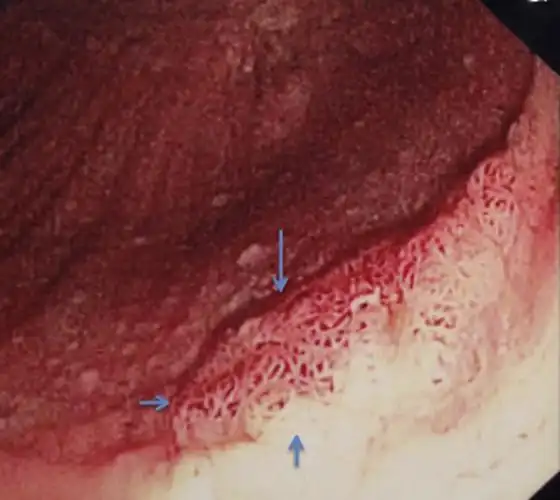 肛门息肉临床的图片_有来医生