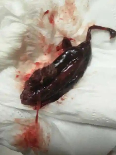 药流当天在医院流出孕囊了,回家两天又流出这个像子宫一样的,帮我看一