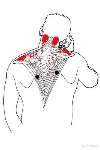 颈肌筋膜疼痛综合征