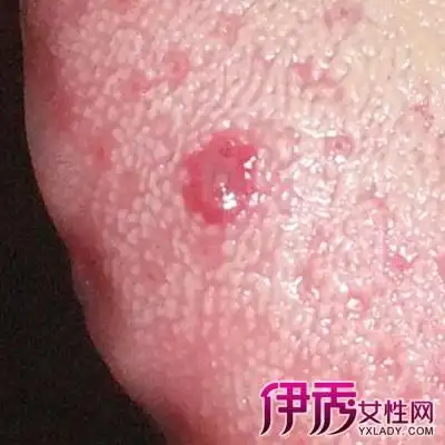 舌头起泡是什么原因 舌头起泡治疗方法介绍