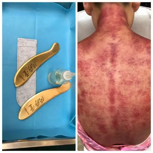 李氏砭法(虎符铜砭刮痧)走上中国-东盟青年高级卫生人才传统医药与临